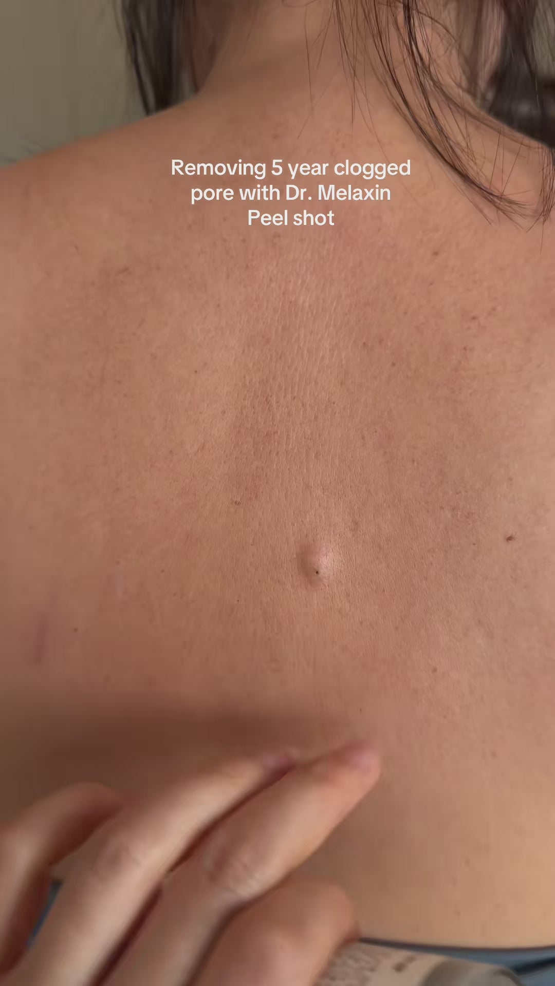 Dr. Melaxin Rice Renewal Shot™ video